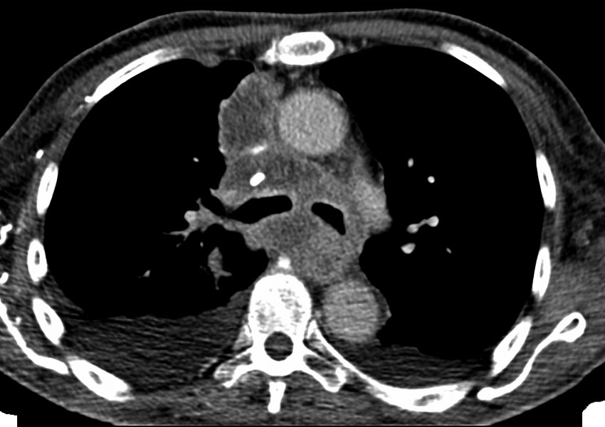 Biopsia de mediastino anterior