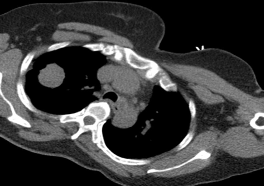 Biopsia Pulmonar