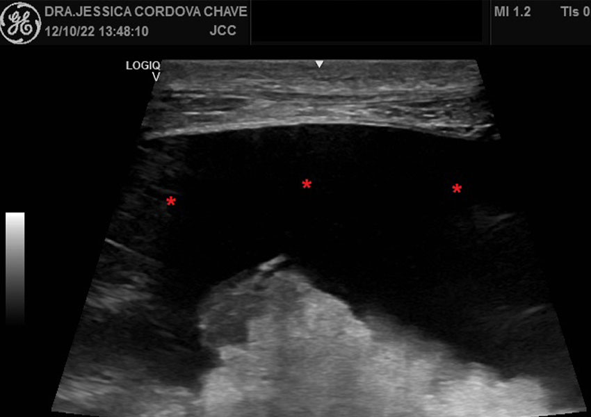 Paracentesis evacuadora